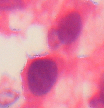 Adenovirus-Infektion Lunge